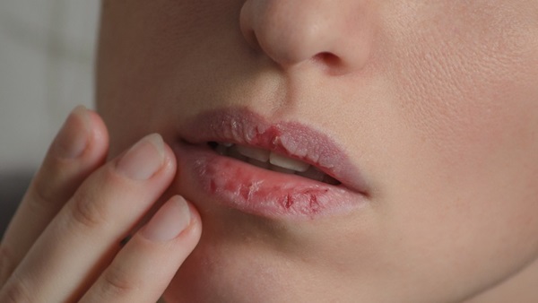 Femme aux lèvres gercées